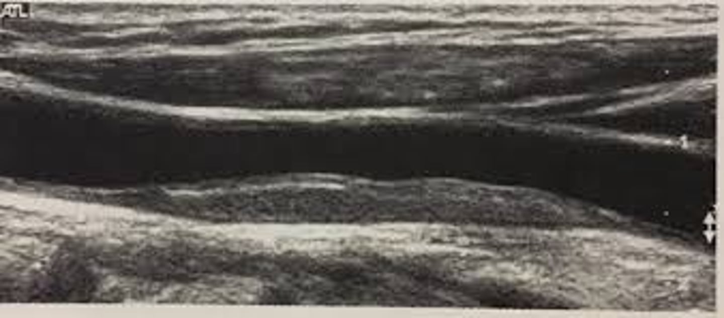 <p>In the following image, how would you describe the arterial wall?</p>