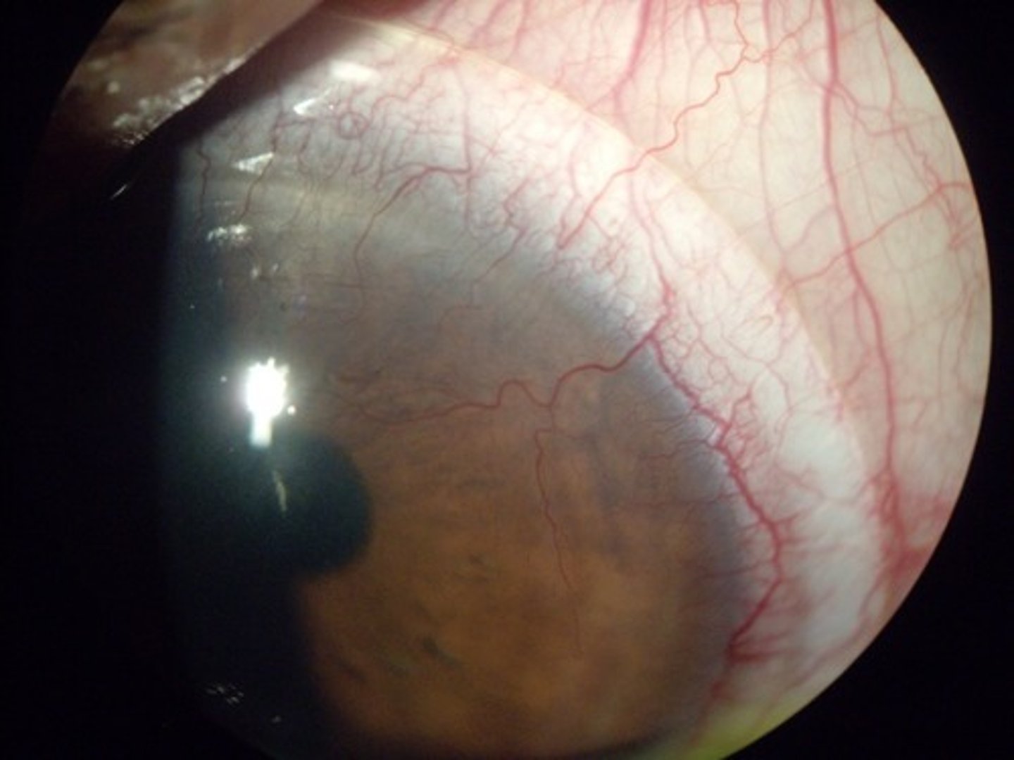 <p>excessive growth of blood vessels from the limbal vascular plexus into cornea, caused by low reception of oxygen</p>