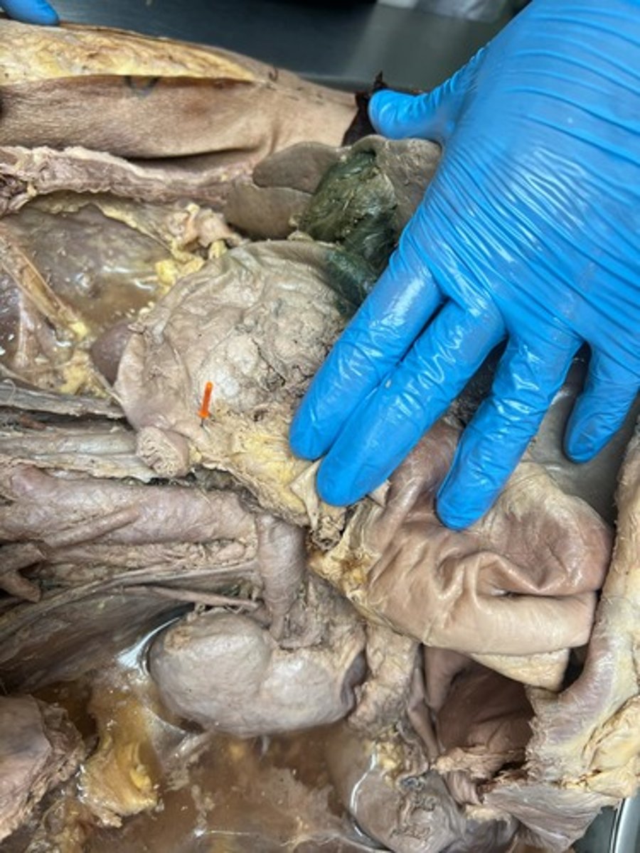 <p>ascending part of duodenum</p>