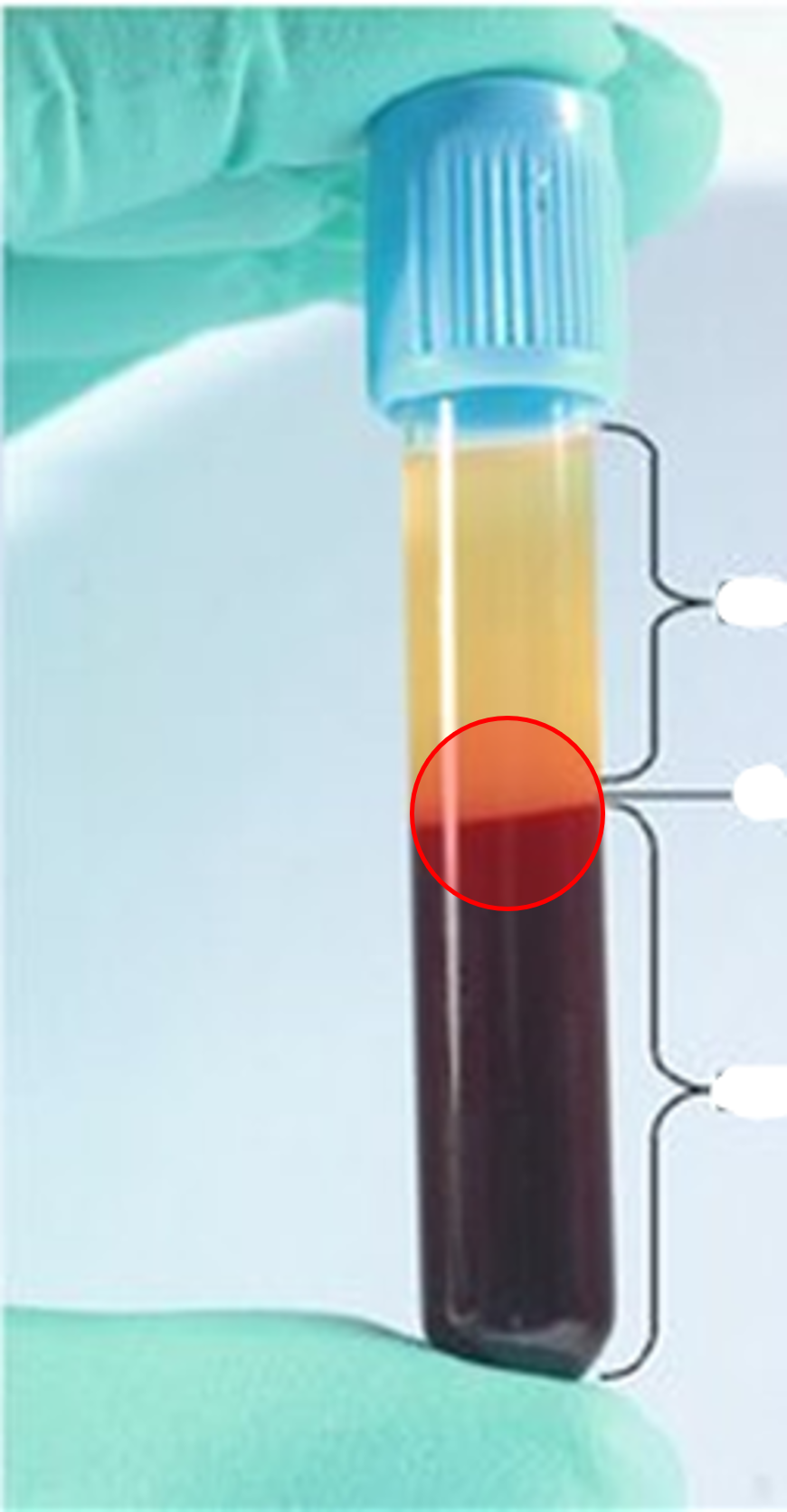 • The thin layer between the red cell layer and the plasma in centrifuged blood.

• Consists of leukocytes and platelets.