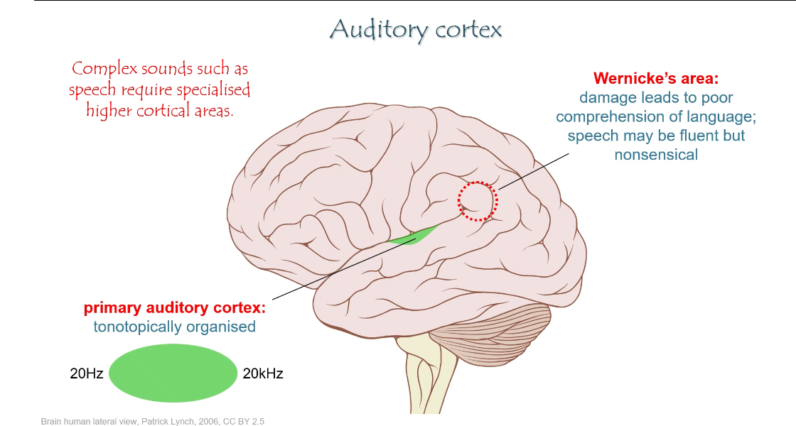 <p></p><ul><li><p>This shows how sound information travels from the ear to the brain</p></li><li><p>It is the primary auditory pathway used for discriminative hearing (pitch, loudness, sound identity)</p></li></ul><p></p><p></p><p><span><strong>Step 1: Cochlear nerve (CN VIII)</strong></span></p><ul><li><p><span>Hair cells in the organ of Corti release glutamate</span></p></li><li><p><span>Signals travel along the cochlear nerve</span></p></li><li><p><span>This nerve is part of the vestibulocochlear nerve (cranial nerve VIII)</span></p></li></ul><p></p><p><span><strong>Step 2: Cochlear nuclei (brainstem)</strong></span></p><ul><li><p><span>First synapse in the auditory pathway</span></p></li><li><p><span>Located in the medulla</span></p></li><li><p><span>From this point, auditory information is sent to both sides of the brain</span></p></li><li><p><span>This bilateral projection explains why damage on one side rarely causes total deafness</span></p></li></ul><p></p><p><span><strong>Step 3: Superior olivary nuclei (brainstem)</strong></span></p><ul><li><p><span>First site of binaural comparison</span></p></li><li><p><span>Important for sound localisation</span></p></li><li><p><span>Compares:<br></span></p><ul><li><p><span>Timing differences (low frequencies)</span></p></li><li><p><span>Loudness differences (high frequencies)</span></p></li></ul></li></ul><p></p><p><span><strong>Step 4: Inferior colliculus (midbrain)</strong></span></p><ul><li><p><span>Major integration centre for sound</span></p></li><li><p><span>Combines information about:<br></span></p><ul><li><p><span>Frequency</span></p></li><li><p><span>Intensity</span></p></li><li><p><span>Timing</span></p></li></ul></li></ul><p></p><ul><li><p><span>Involved in sound localisation and auditory reflexes</span></p></li></ul><p></p><p></p><p><span><strong>Step 5: Medial geniculate nucleus (thalamus)</strong></span></p><ul><li><p><span>The auditory relay nucleus of the thalamus</span></p></li><li><p><span>Filters and organises auditory input</span></p></li><li><p><span>Sends processed signals to the auditory cortex</span></p></li></ul><p></p><p></p><p><span><strong>Step 6: Primary auditory cortex (A1)</strong></span></p><ul><li><p><span>Located in the temporal lobe</span></p></li><li><p><span>Tonotopically organised:<br></span></p><ul><li><p><span>Low frequencies map to one region</span></p></li><li><p><span>High frequencies map to another</span></p></li></ul></li></ul><p></p><ul><li><p><span>This is where sound becomes consciously perceived</span></p></li></ul><p></p><p><span><strong>Higher auditory cortical areas</strong></span></p><ul><li><p><span>Surround the primary auditory cortex</span></p></li><li><p><span>Process complex sounds, especially speech</span></p></li><li><p><span>Include Wernicke’s area:<br></span></p><ul><li><p><span>Responsible for language comprehension</span></p></li><li><p><span>Damage → fluent but meaningless speech (poor understanding)</span></p></li></ul></li></ul><p></p><p><strong>Key exam points to remember</strong></p><ul><li><p>Pathway is mostly bilateral after the cochlear nuclei</p></li><li><p>Thalamic relay = medial geniculate nucleus</p></li><li><p>Primary auditory cortex is tonotopic</p></li><li><p>Wernicke’s area = understanding speech, not producing it</p></li></ul><p></p>