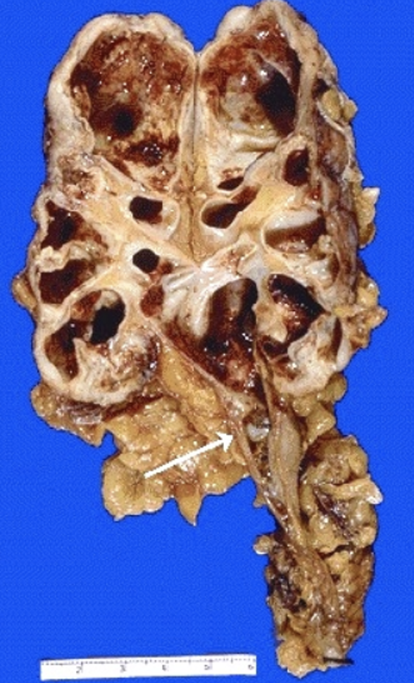 <p>What pathology is indicated by this image? What is indicated at the arrow?</p>