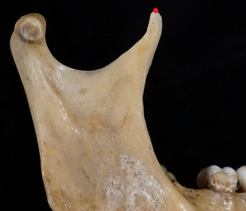 <p>Point at tip of coronid process on mandible</p>