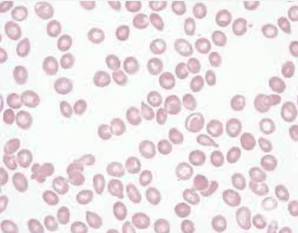 <p>What type of smear cell and what conditions is it seen in</p>
