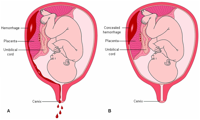 <p>Placenta Abruptio</p>