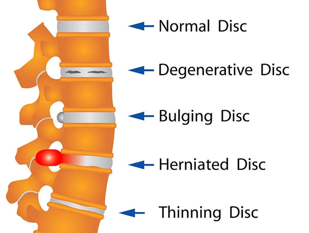<p>Bulging Disc</p>