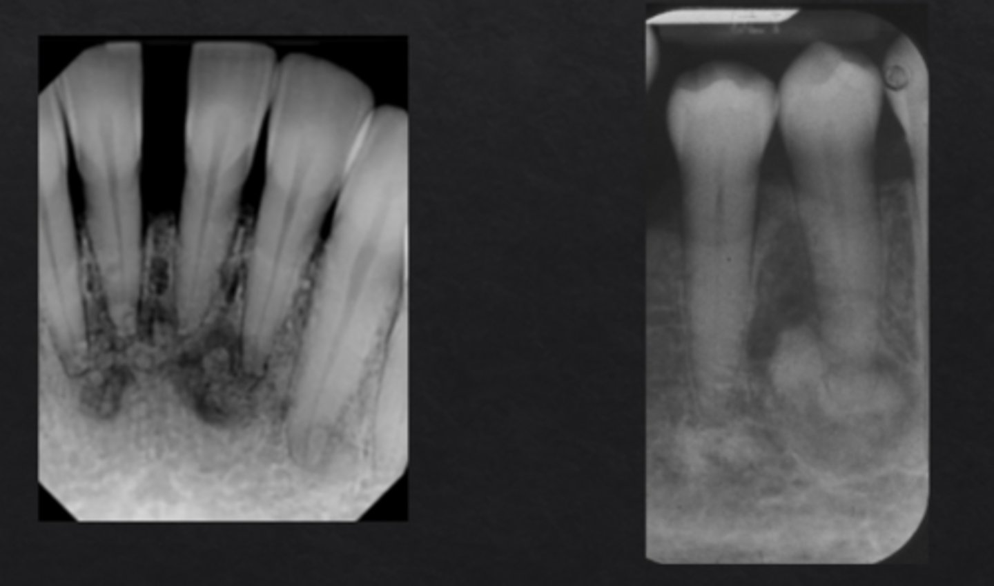 <p>Preapical radiolucency with central calcifications, will become more calcified over time (may lose radiolucent rim)</p>