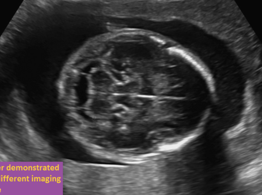 <p>if the fetus is in breech position, where is the left lobe of the cerebellum</p><p>a) top</p><p>b) bottom</p>