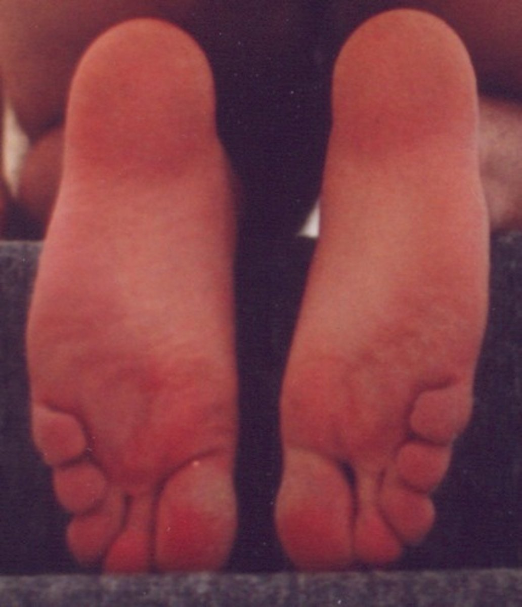 <p>Sole of the foot</p>