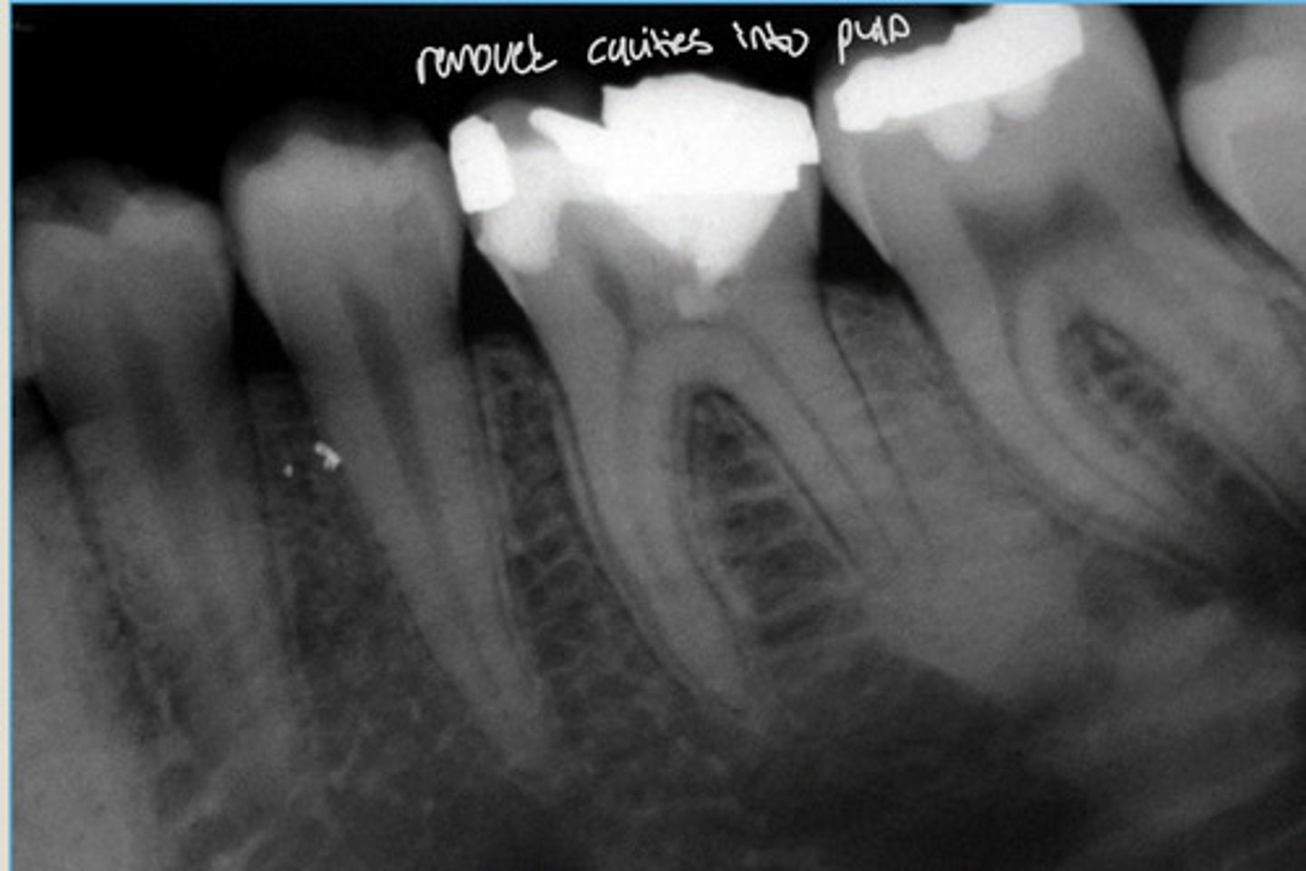 <p>well defined, no radiolucent rim</p>
