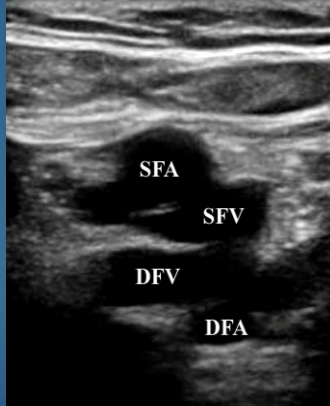 <p>What is site 4 for DVT?</p>