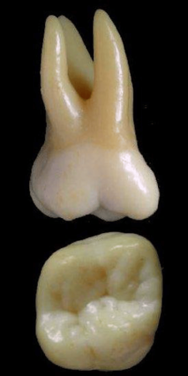 <p>what tooth is this &amp; why?</p>