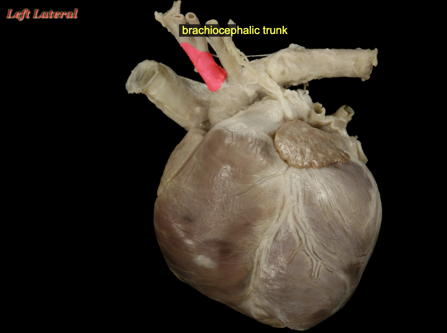 <p>Brachiocephalic trunk</p>