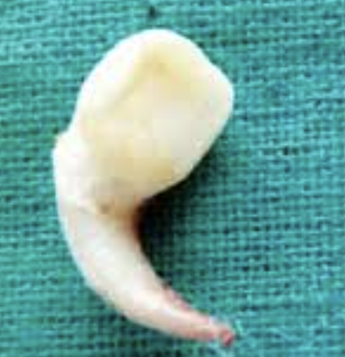 <p>distorted shape bend in crowns and usual root curvatures more common than any other incisor</p>