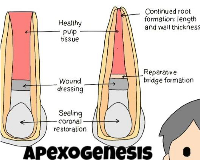 <p>Treat <strong>vital</strong> pulp of immature tooth- CaOH paste to dress wound&nbsp;</p><p>Immature tooth with icomplate or oft and damage to coronal pulp&nbsp;</p><p>Crown with possibility of restoration&nbsp;</p>