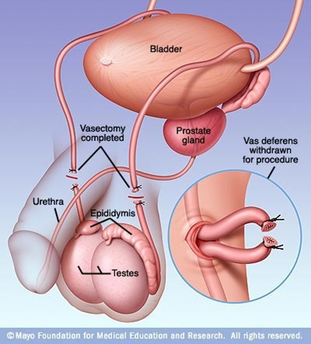 <p>Surgical cutting of vas deferens for male sterilization.</p>