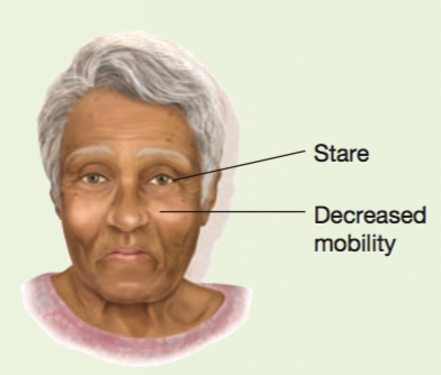 <p>decreased facial mobility blunts expression.</p><p>decreased blinking and a characteristic stare present.</p><p>patient seems to peer upward towards observer.</p><p>facial skin becomes oily and drooling may occur.</p>