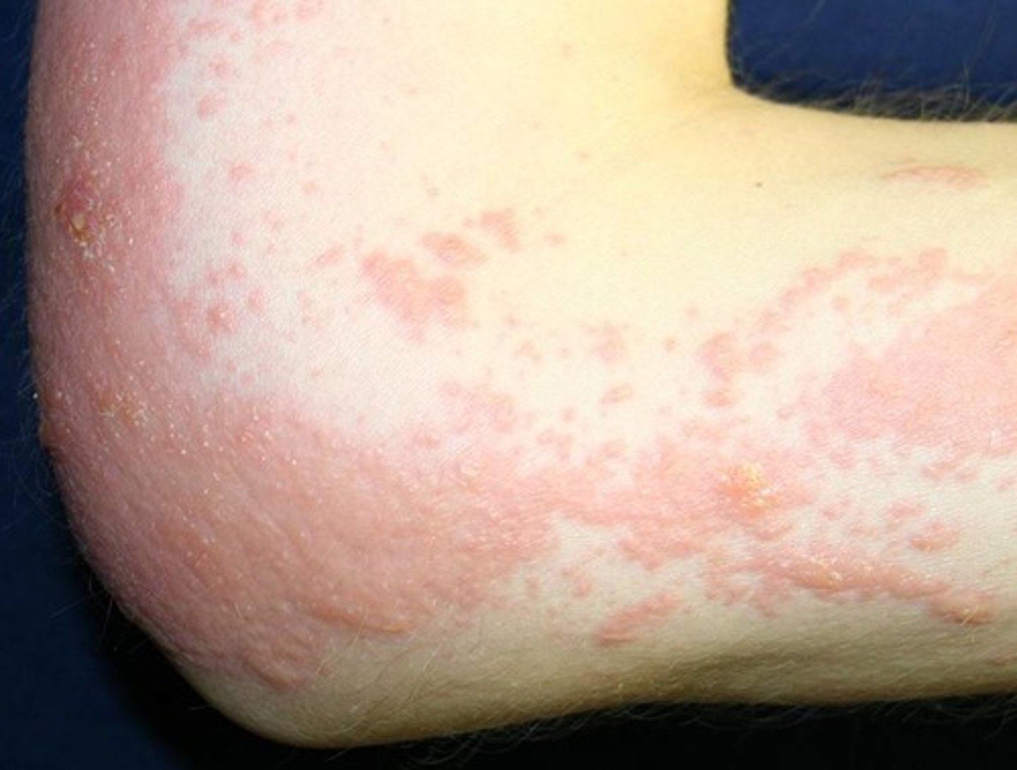 <p>Caused by contact of the skin with an offending substance that creates a neoantigen that T-Cells respond to</p>