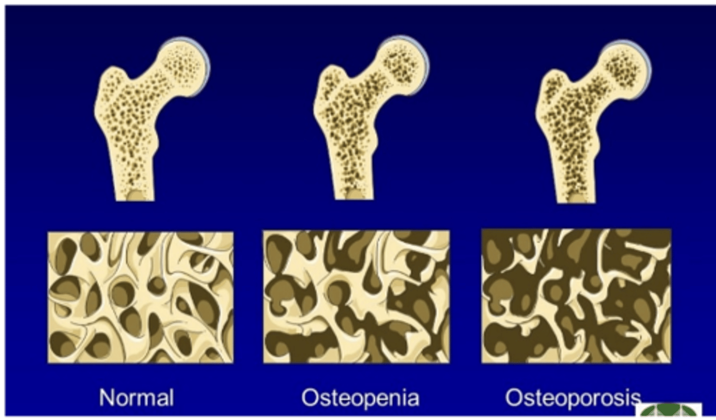 <p>Reduction in bone mass</p><p>-- Term used to describe lack of bone mass on x-ray (not a diagnosis)</p><p>-- Measured as Bone Mineral Density >1 standard deviation below young adult reference population</p><p>Causes:</p><p>-- Decrease in bone formation</p><p>-- Inadequate bone mineralization</p><p>-- Excessive bone resorption</p><p>______________ is present in:</p><p>-- Osteoporosis</p><p>-- Osteomalacia</p><p>-- Malignancies such as multiple myeloma</p><p>-- Endocrine disorders such as hyperparathyroidism and hyperthyroidism</p>