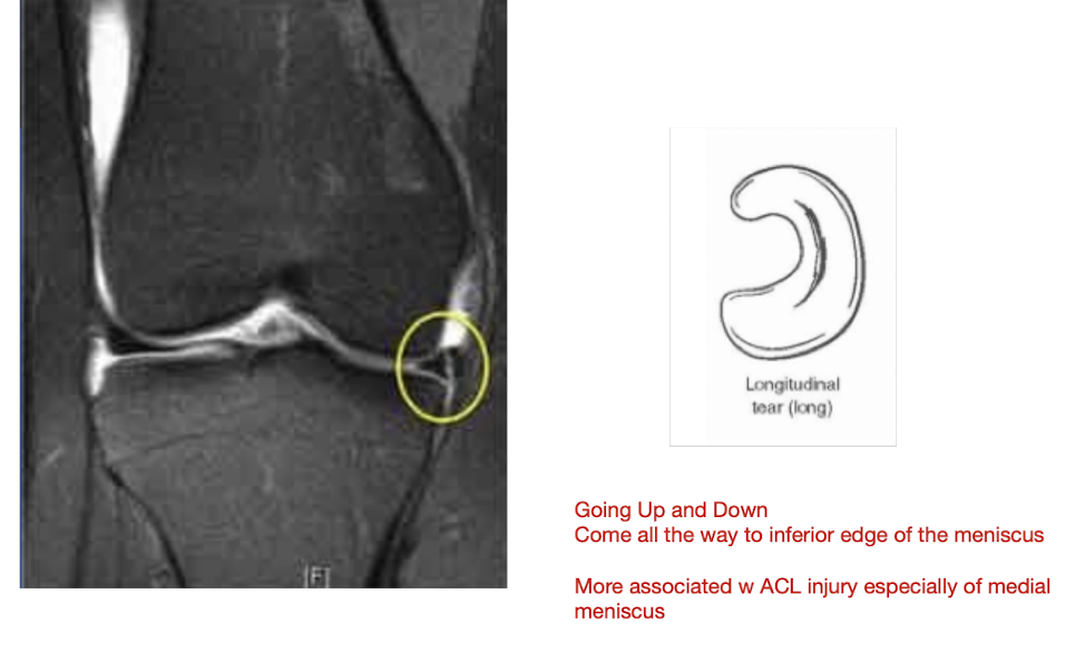 <p>Longitudinal Vertical Tear:</p><ul><li><p>___ to the Tibial Plateau </p></li><li><p>___ to the what?</p></li></ul><p></p><p></p>