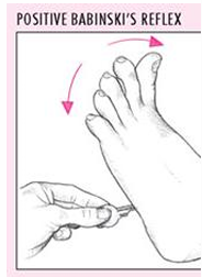 <p>A positive Babinski sign indicates damage to upper motor neurons, except at what age where it is normal?</p>
