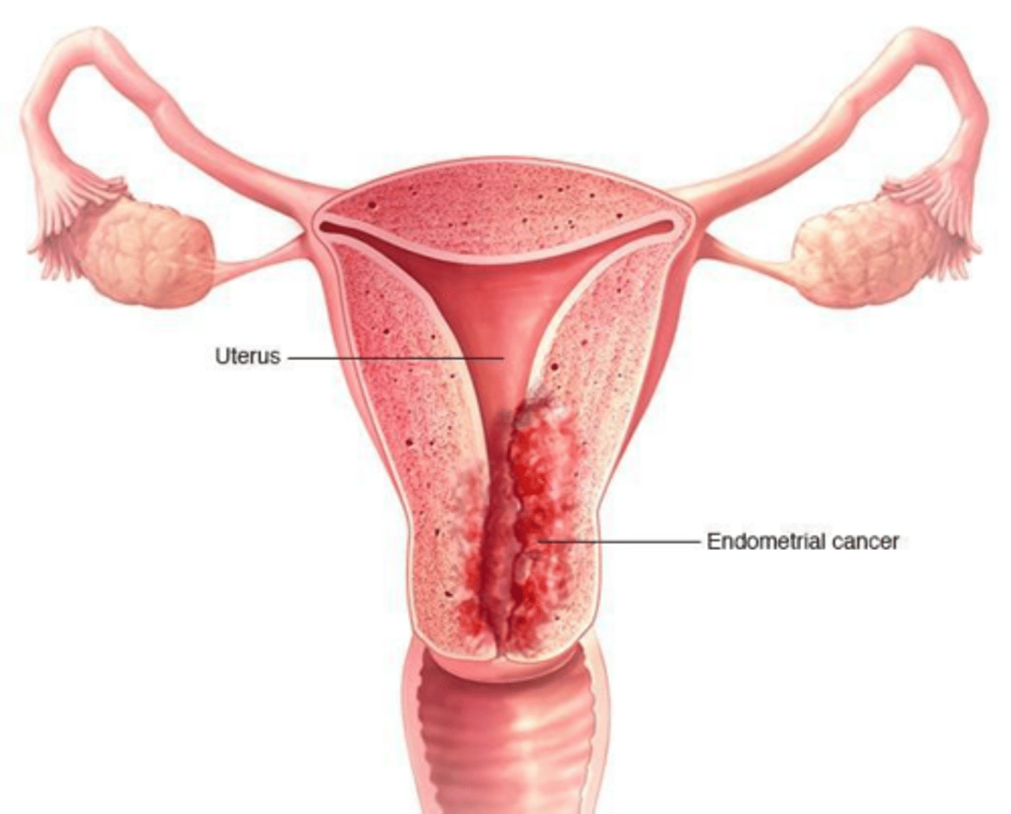 <p>Endometrial cancer.</p>
