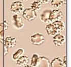 <p>occurs in concentrated urine</p>