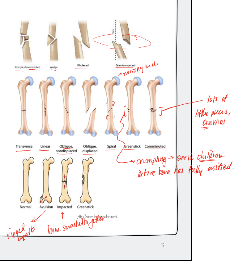 <p>transverse, linear, oblique, spiral, greenstick, comminuted, avulsion, impacted, open/compound</p>