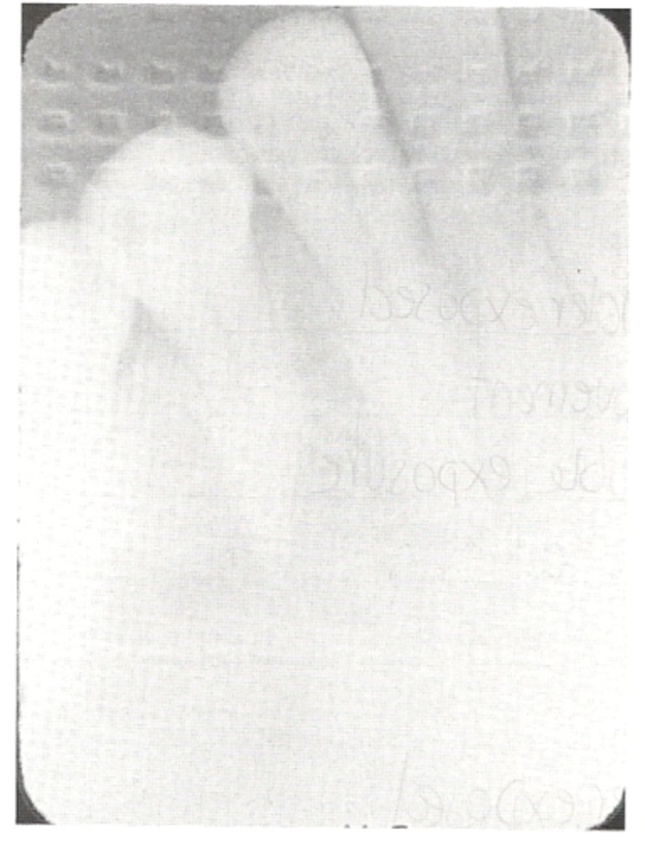 <p>with film: light image with herringbone pattern</p><p>with sensor: no image produced</p><p>with PSP digital plate it is difficult to identify</p><p>always place the receptor with the proper side towards the tubehead</p>