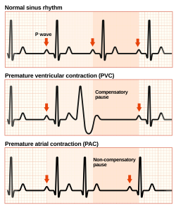 <ul><li><p>P wave: <strong>Absent</strong> (originates in ventricles)</p></li><li><p>QRS: <strong>Wide, bizarre</strong></p></li><li><p>PR Interval: <strong>Not measurable</strong></p></li><li><p>Rhythm: <strong>Irregular</strong> (due to premature beat)</p></li><li><p>Notes: Often followed by a compensatory pause; may be unifocal or multifocal</p></li></ul><p></p>