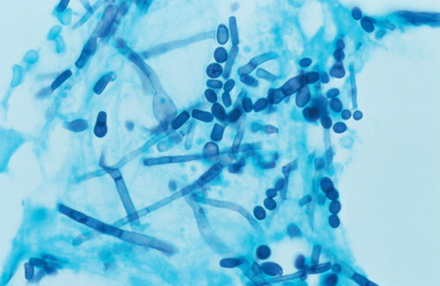 <p>T. ovoides, T. asteroides, T. inkin and Cutaneotrichosporon cutaneum have been implicated in most cases of superficial mycoses. T. asahii is implicated in severe and frequently fatal disease in immunocompromised hosts. T. mucoides also causes systemic disease (meningitis) and is recovered frequently from CSF.</p>