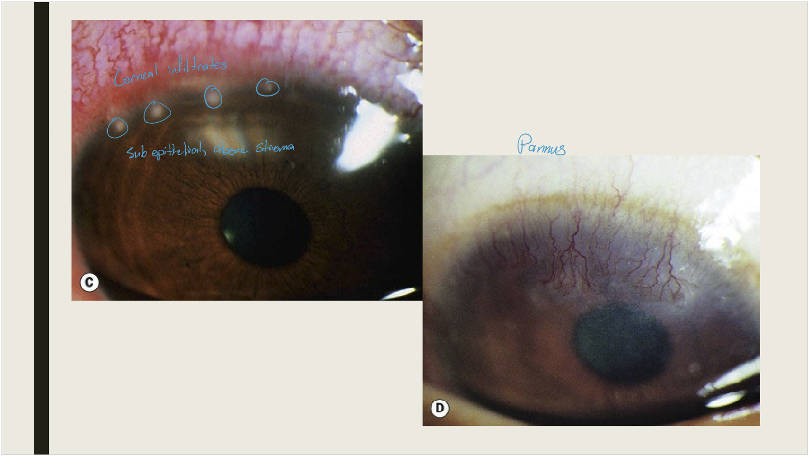 <ul><li><p>Water or mucopurlulent discharge&nbsp;</p></li><li><p>Large follicles prominent in the inferior fornix or superior tarsal plate</p></li><li><p>PEE</p></li><li><p>Peripheral subepithelial corneal inflitrates: may have 2-3 week delay of onset</p></li><li><p>Tender preauricular lymphadenopathy</p></li><li><p>Con scarring and corneal pannus is seen with chronic infections&nbsp;</p></li></ul><p></p>