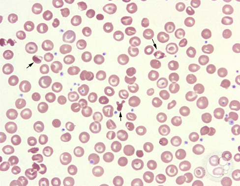 <p>what disease/condition is associated with increased codocytes, Hb C crystals, and sickle cells?</p>