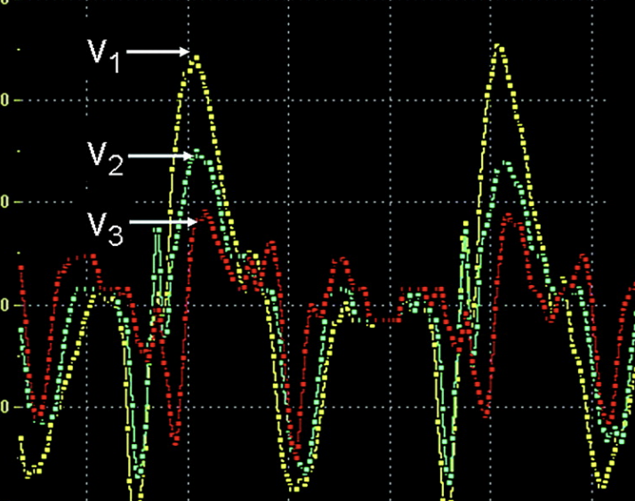 <p> SR	=(V1- V2)/D  (s<sup>-1</sup>)</p>