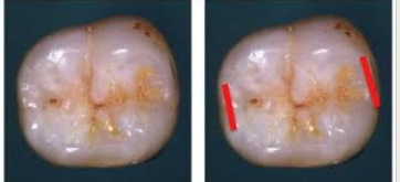 <p>Ridge or elevation of enamel forming the margin of the surface of a tooth, at the mesial and distal margins of the occlusal surfaces of premolars and molars and at the mesial and distal margins of the lingual surfaces of incisors and canines. </p>
