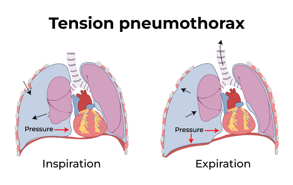 <p>One-way valve effect trapping air in the pleural space → decreases ventilation and venous return → a life-threatening emergency</p>