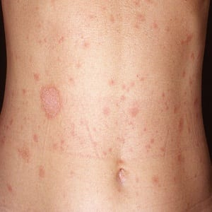 <p>non-contagious rash that starts with a single, larger patch (herald patch) followed by smaller, scaly, pink or reddish oval shaped spots; itchy and can last for several weeks.</p><p>causes is unknown, believed to be viral infection with possible triggers (HHV 6 or 7, epstein-barr virus, cytomegalovirus)</p><p>MC on chest, abdomen, thighs, back</p>