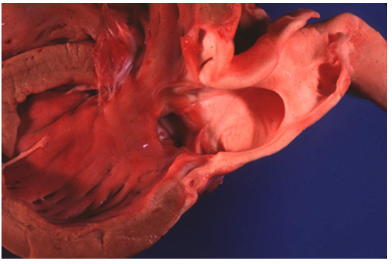 <p>Name this heart pathology</p>