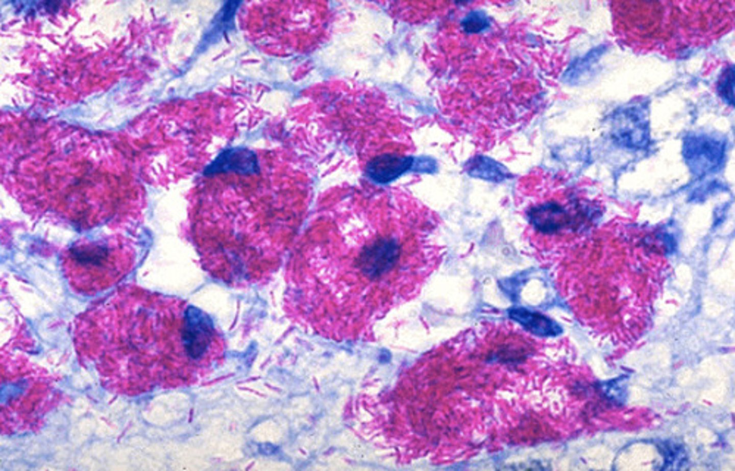 <p>An acid fast stain was performed on the ileum, what pathogen is taking up the stains in the slide?</p>