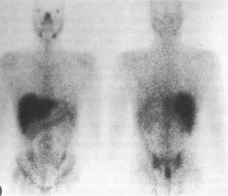 <p>Gallium scan</p>