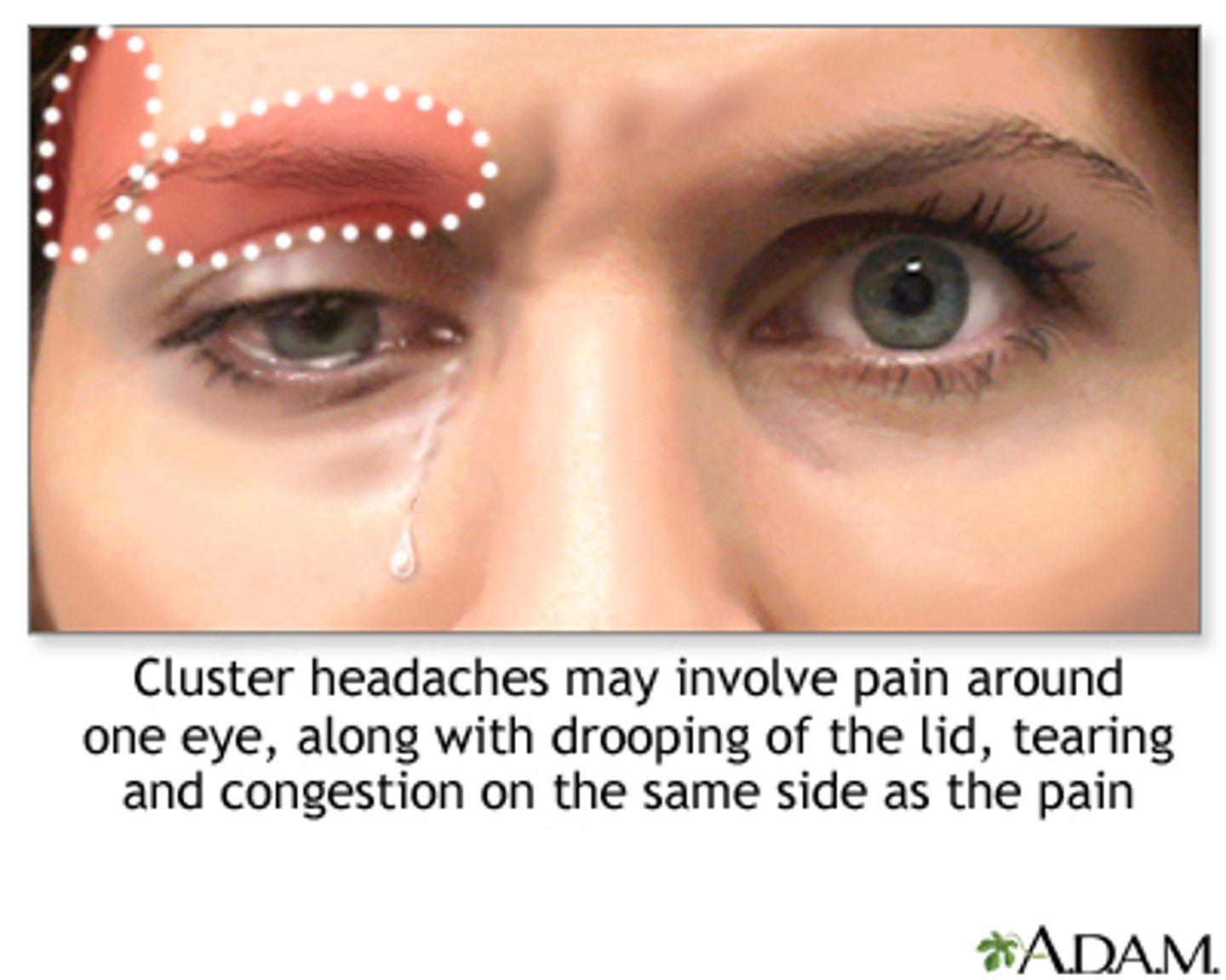<p>severe, boring/burning unilateral pain for 45-60mins that often onset at sleep (peak in spring and fall) = clusters of HA for 8-12 weeks = remission for 12-18 mos</p>