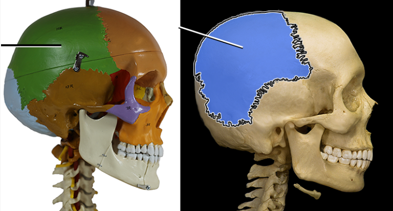 <p>Posterior to the frontal bone are the left and right ___ bones. Form the superior sides of the cranium.</p>