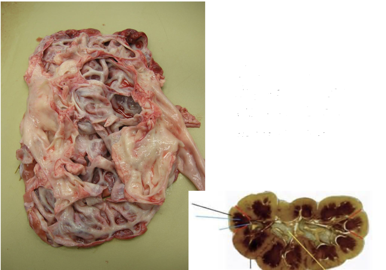 <p>What cellular adaptation would you expect to see with this disease?</p>