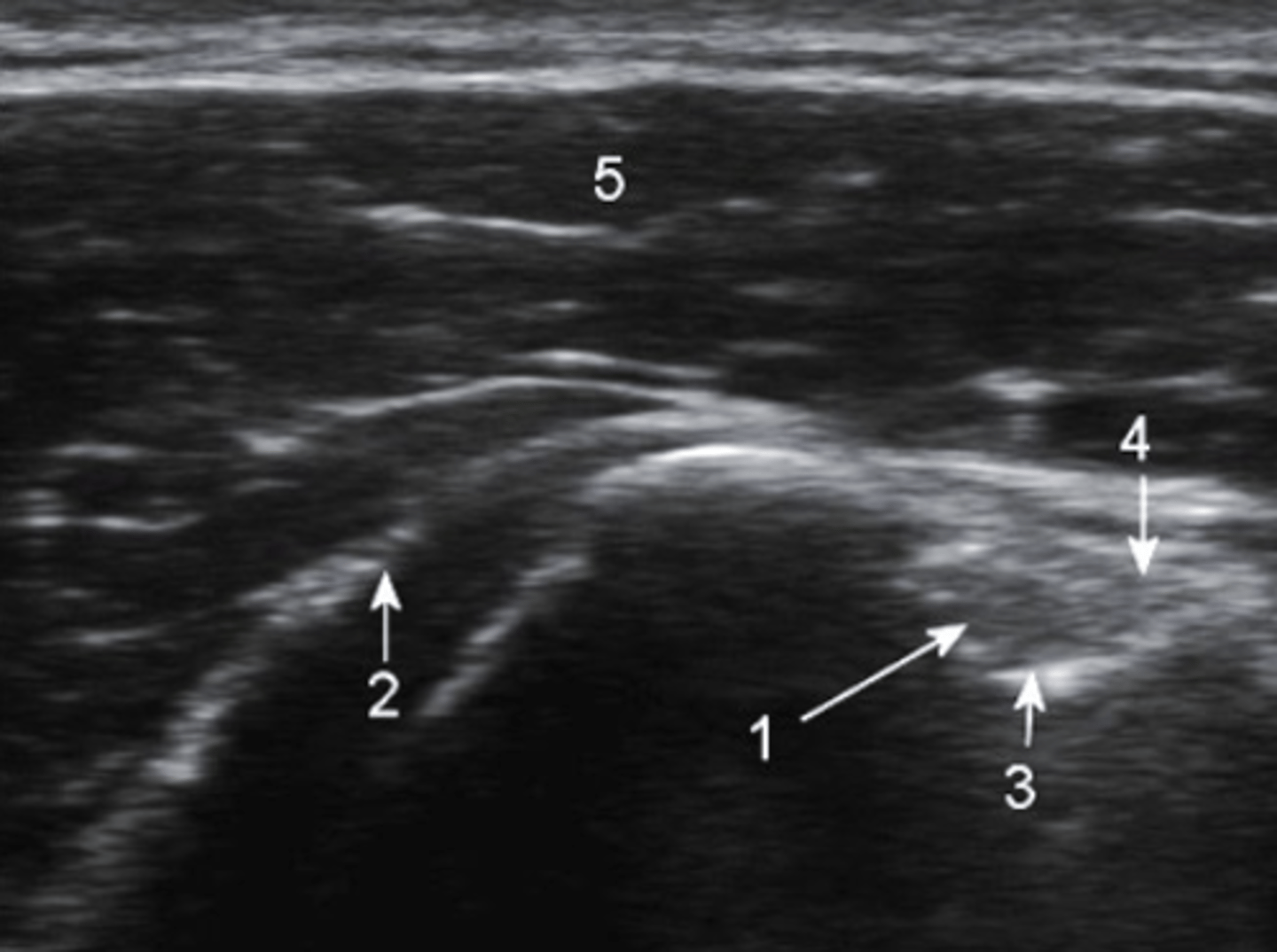 <p>What type of imaging is this and how is it being viewed?</p><p>a. ultrasound, longitudinal</p><p>b. T2 MRI, frontal</p><p>c. CT Scan, axial</p><p>d. ultrasound, transverse</p>