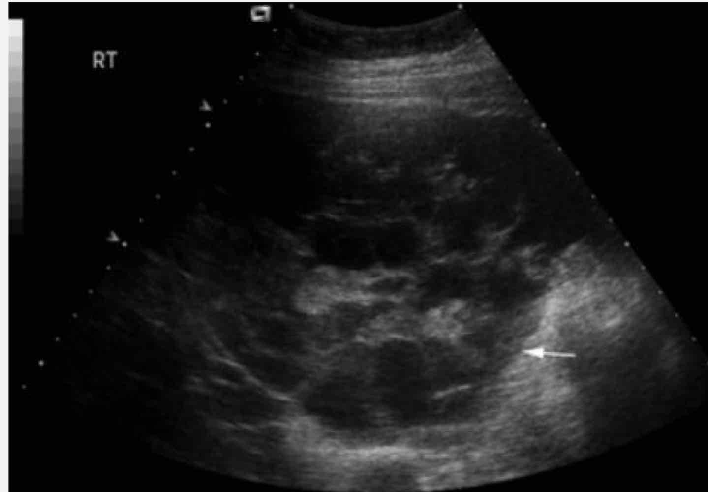<p>large and multilocular cystic mass with loculated ascites</p><p>Age: 40-70 yo</p>