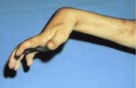 <p>flexion contraction of the wrist and fingers&nbsp;</p>