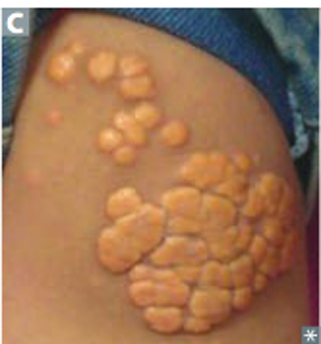 <p>Term for the yellow colored raised growths due to excess lipids (lipidosis) mainly due to high LDL levels. They are often associated with inherited disorders of lipid metabolism (inherited problems with the way that fats are broken down and used), such as in familial hypercholesterolemia (FH). The growths are caused by accumulations of lipid-laden macrophages (foam cells). The excess LDLs containing fat/cholesterol-rich material are taken up by macrophages and become foam cells. Accumulations of these cells cause the growth and can appear anywhere in the body.</p>