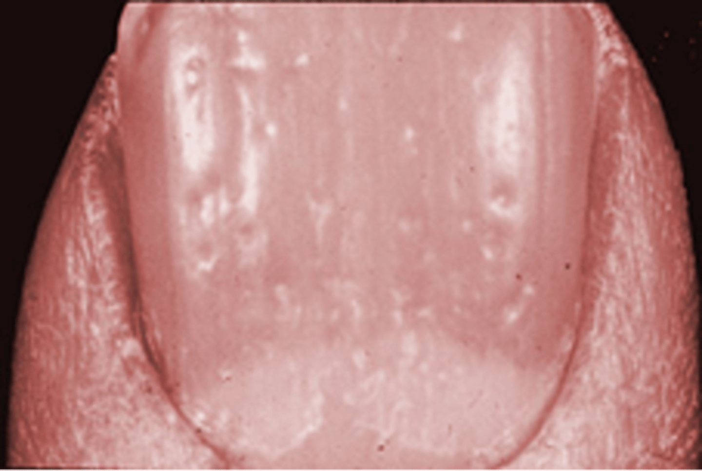 <p>◦Psoriasis, psoriatic arthritis</p>