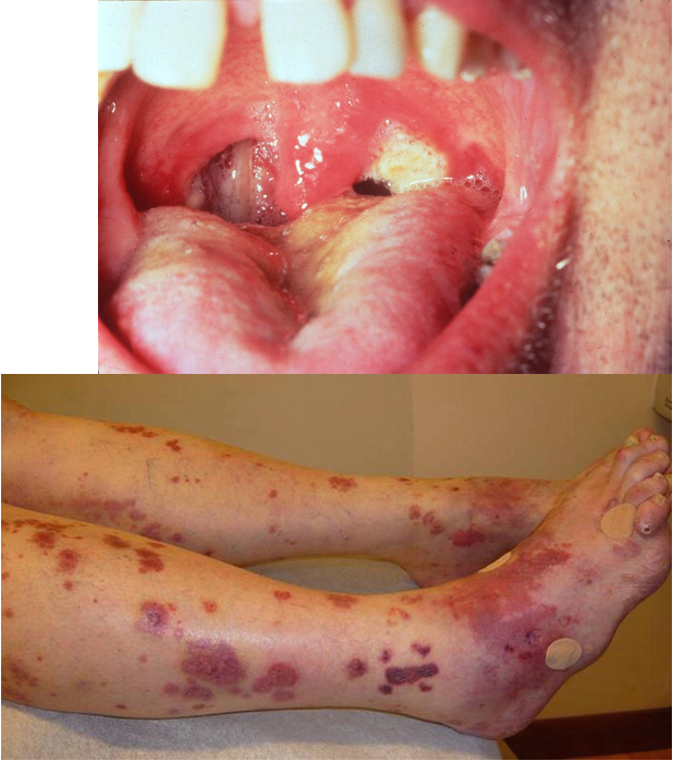 <ul><li><p>purpura w/ focal necrosis</p></li><li><p>oral/nasal ulcerations</p></li><li><p>skin ulcers</p></li><li><p>papules, vesicles, palpable purpura</p></li><li><p>triad:</p><ul><li><p>necrotizing granuloma in upper resp. tract and lungs</p></li><li><p>vasculitis involving both arteries and veins</p></li><li><p>glomerulitis</p></li></ul></li><li><p>location: lower limbs, face, trunk, upper extremities</p></li></ul><p></p>