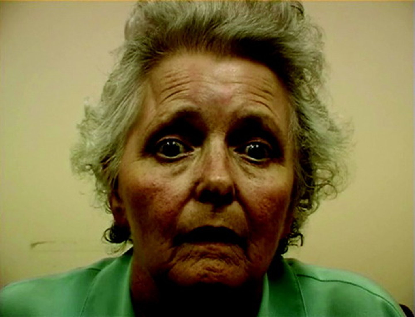 <p>Primarily vertical gaze deficits, parkinsonism, unexplained falls</p>